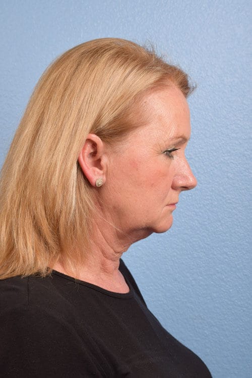 Neck Lift Before & After Gallery - Patient 207141 - Image 5