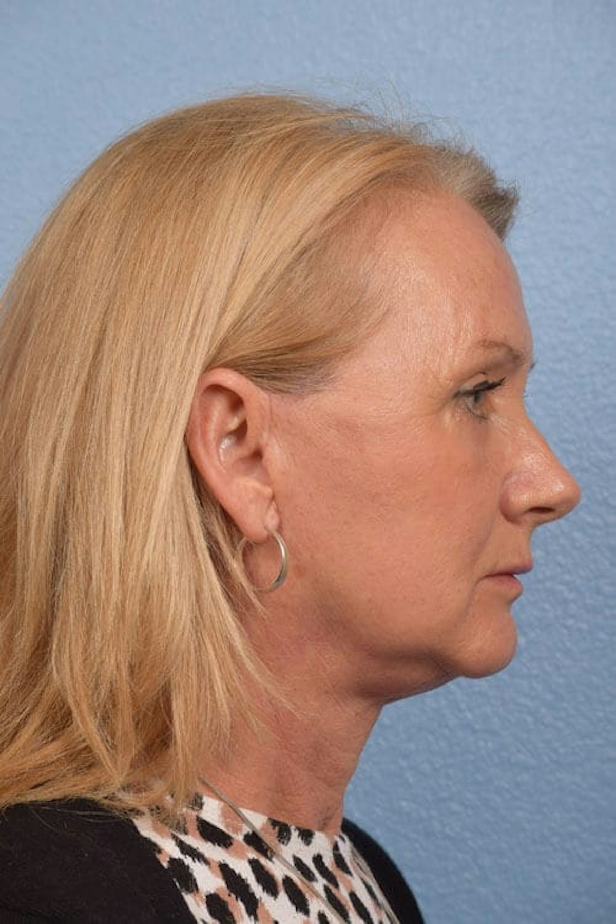 Neck Lift Before & After Gallery - Patient 207141 - Image 6