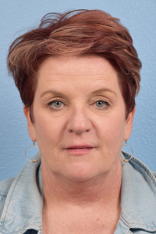 Hidden Patients Before & After Gallery - Patient 167428 - Image 1