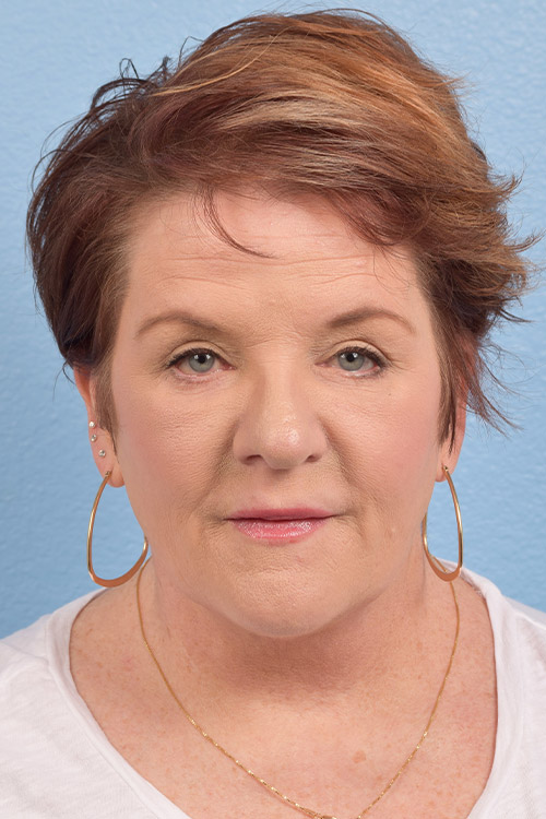 Hidden Patients Before & After Gallery - Patient 167428 - Image 2