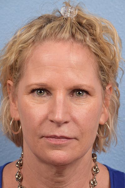 Blepharoplasty Before & After Gallery - Patient 216006 - Image 1