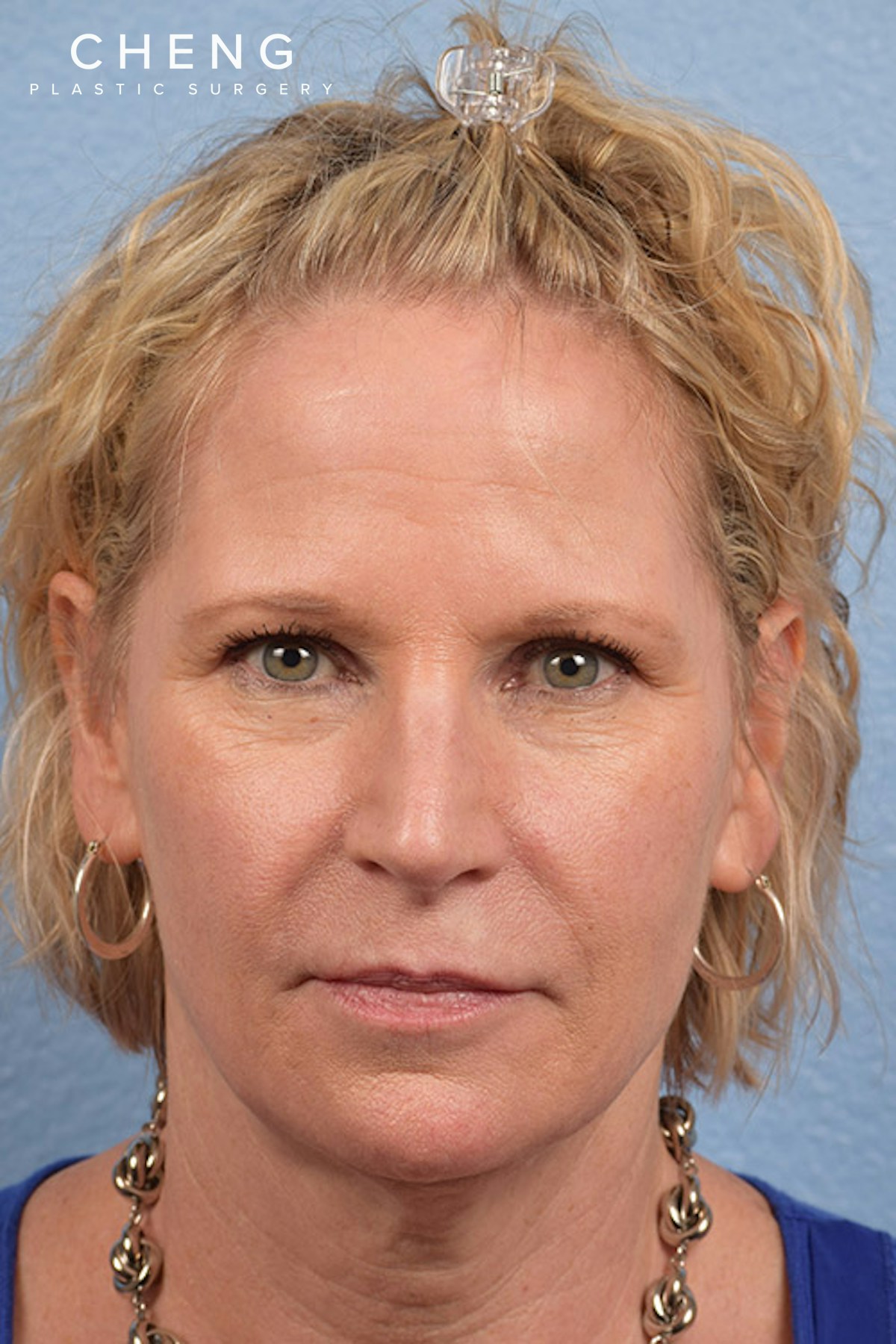 Hidden Patients Before & After Gallery - Patient 530071 - Image 1