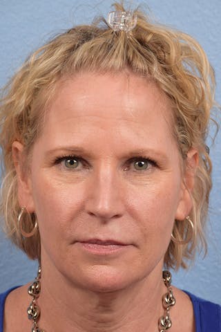 Hidden Patients Before & After Gallery - Patient 530071 - Image 1