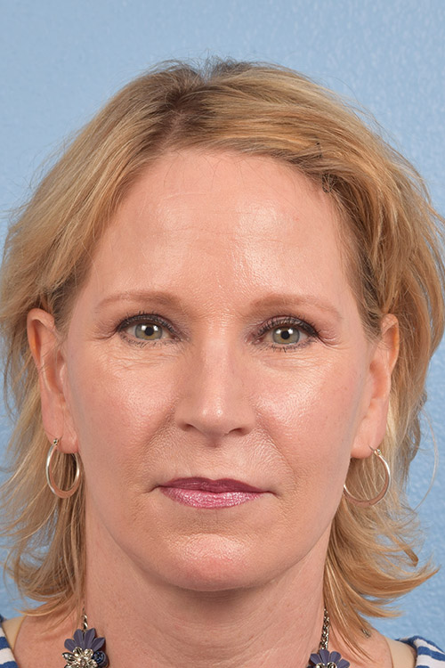 Fat Transfer Before & After Gallery - Patient 313784 - Image 2