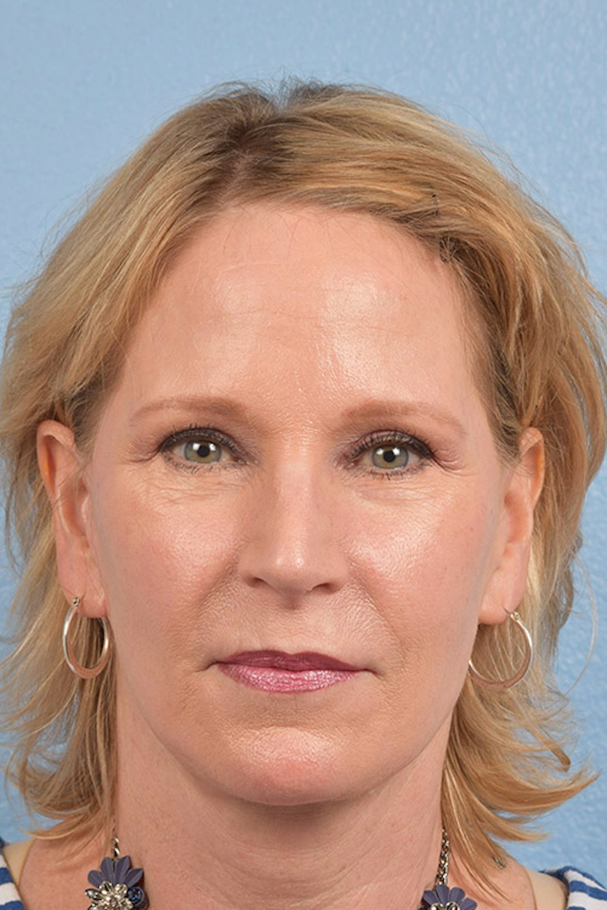Blepharoplasty Before & After Gallery - Patient 216006 - Image 2