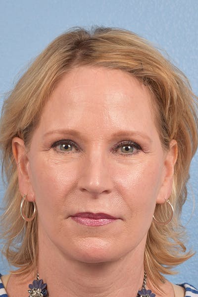 Blepharoplasty Before & After Gallery - Patient 216006 - Image 2