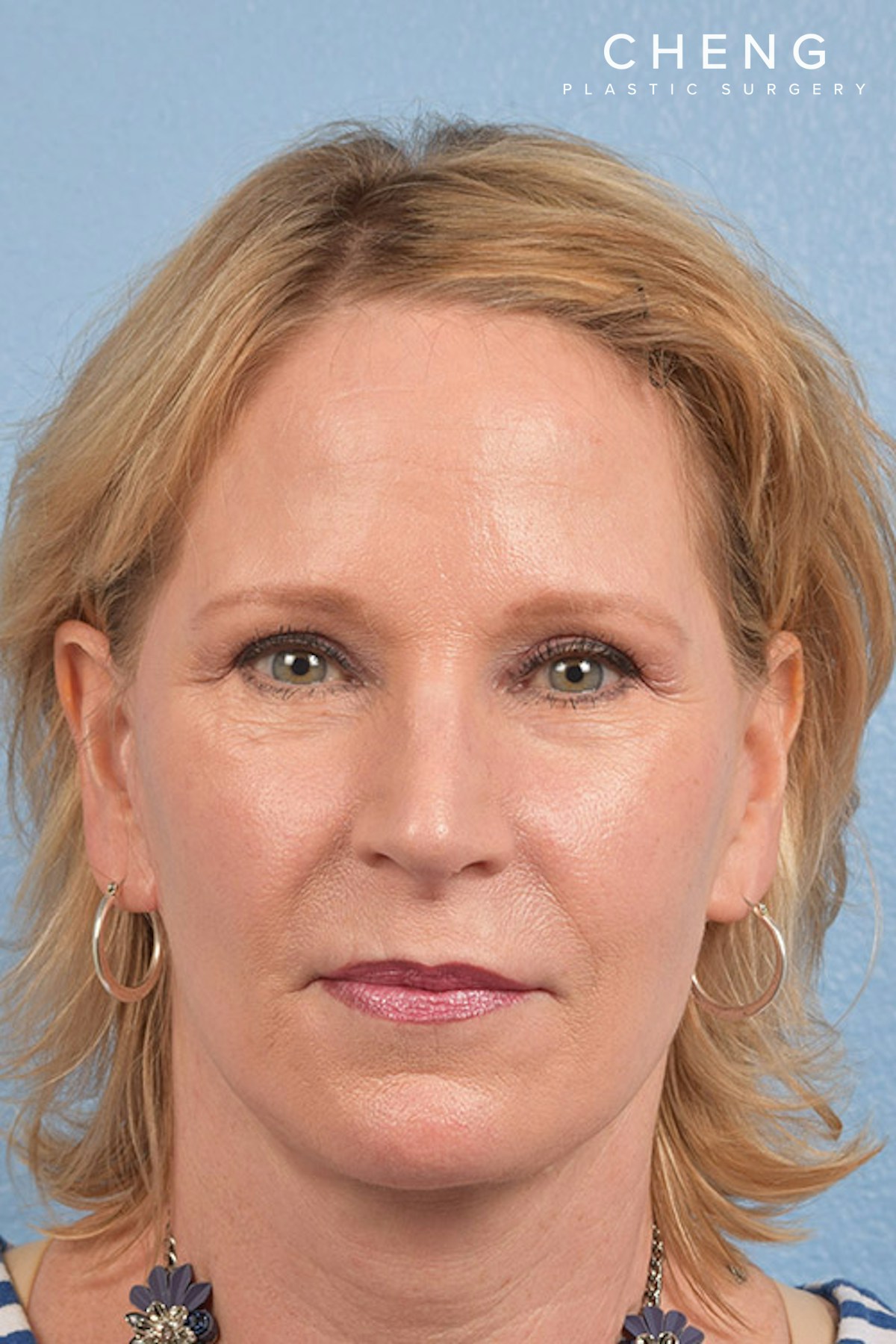 Hidden Patients Before & After Gallery - Patient 530071 - Image 2