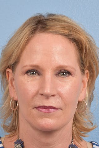 Hidden Patients Before & After Gallery - Patient 530071 - Image 2