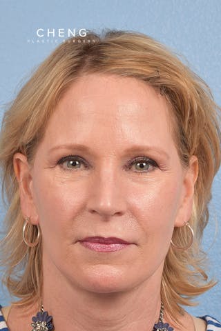 Hidden Patients Before & After Gallery - Patient 530071 - Image 2