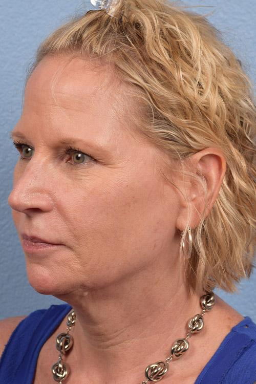 Fat Transfer Before & After Gallery - Patient 313784 - Image 3