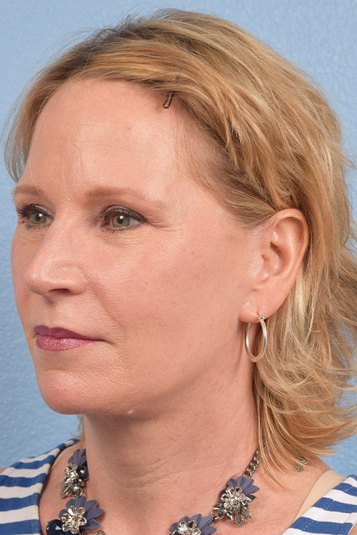 Fat Transfer Before & After Gallery - Patient 313784 - Image 4