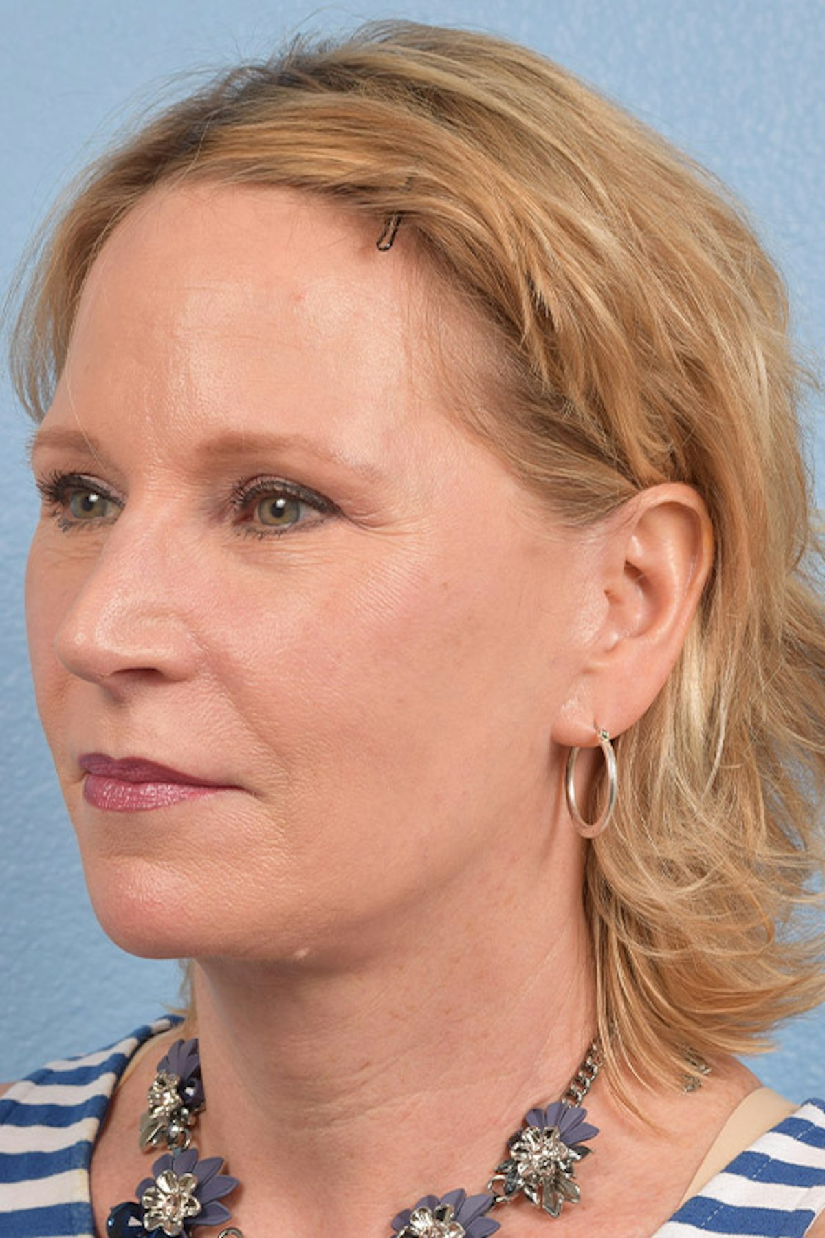 Blepharoplasty Before & After Gallery - Patient 216006 - Image 4