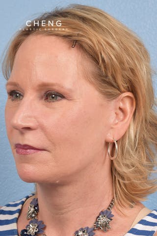 Hidden Patients Before & After Gallery - Patient 530071 - Image 4