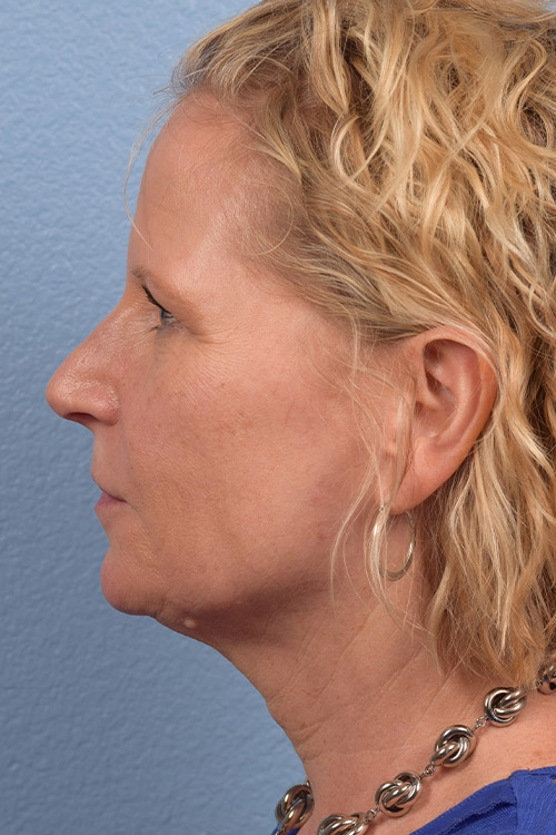 Fat Transfer Before & After Gallery - Patient 313784 - Image 5