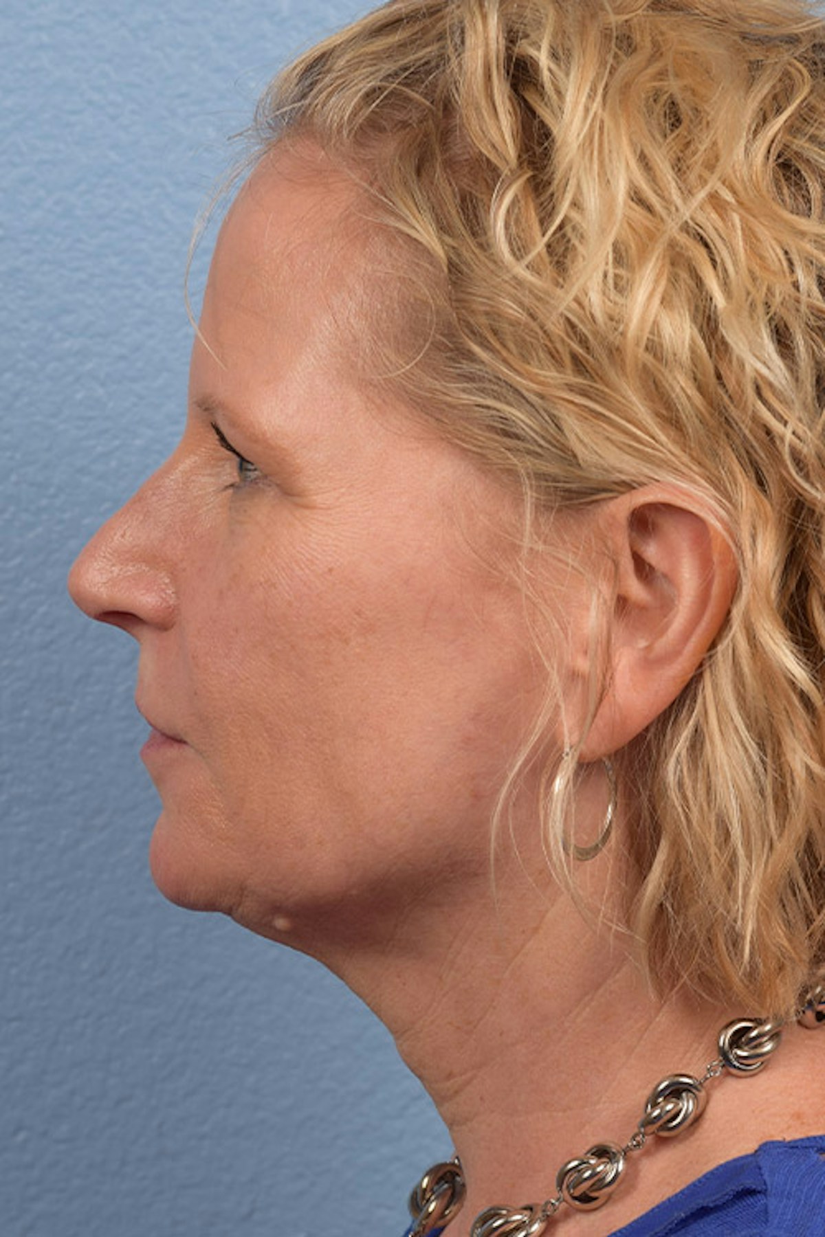 Blepharoplasty Before & After Gallery - Patient 216006 - Image 5