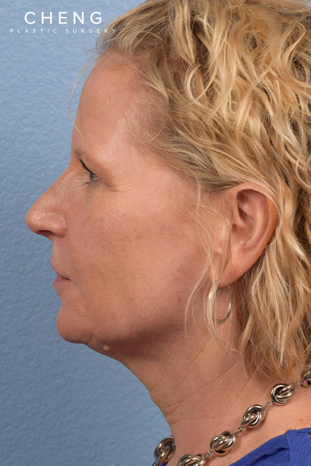 Hidden Patients Before & After Gallery - Patient 530071 - Image 5