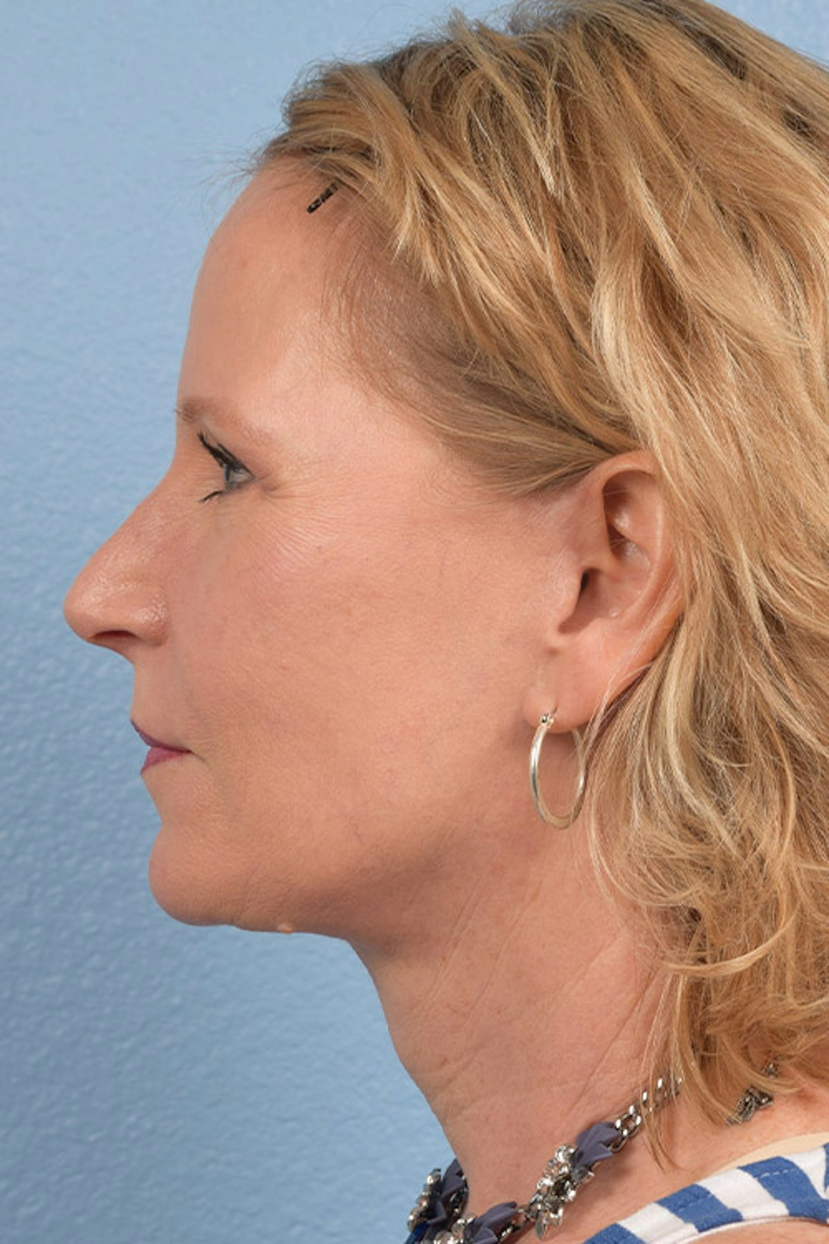 Blepharoplasty Before & After Gallery - Patient 216006 - Image 6