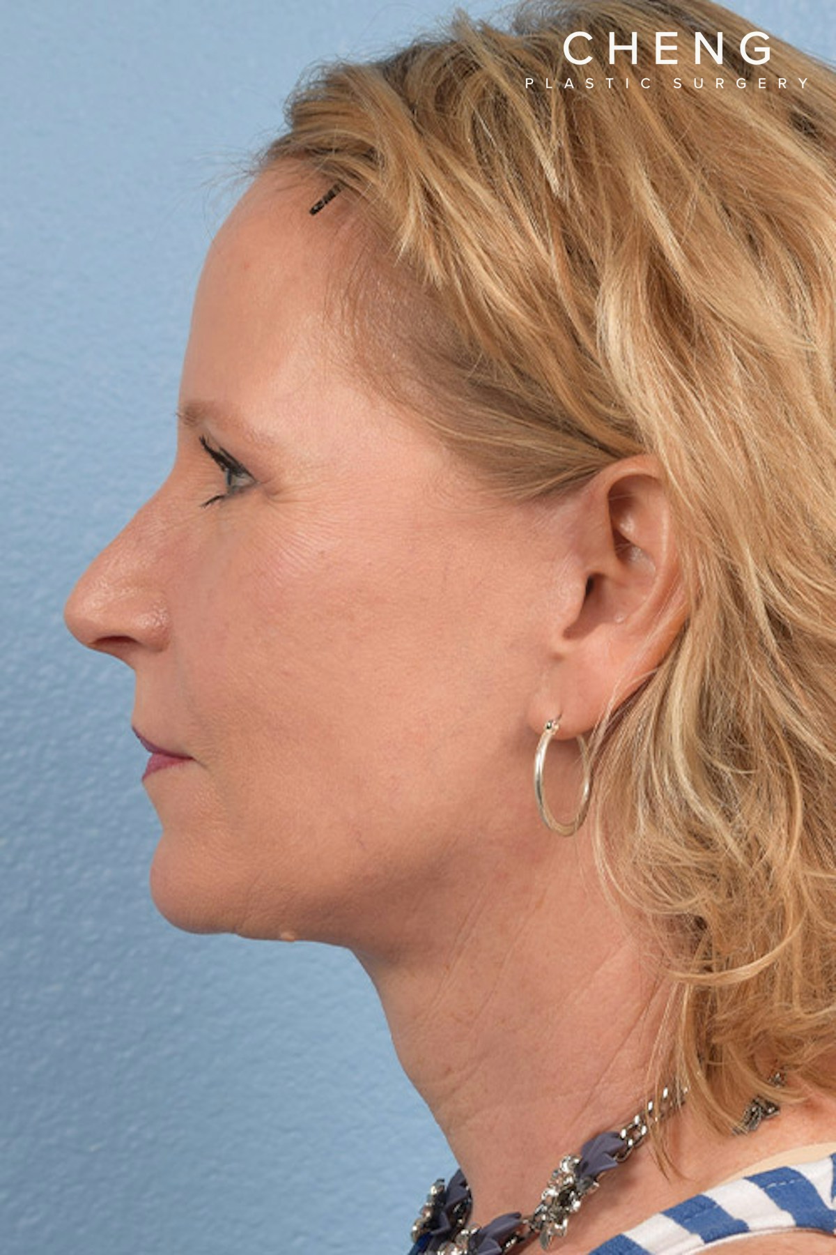 Hidden Patients Before & After Gallery - Patient 530071 - Image 6