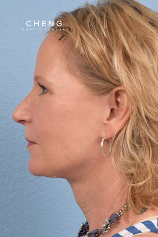 Hidden Patients Before & After Gallery - Patient 530071 - Image 6