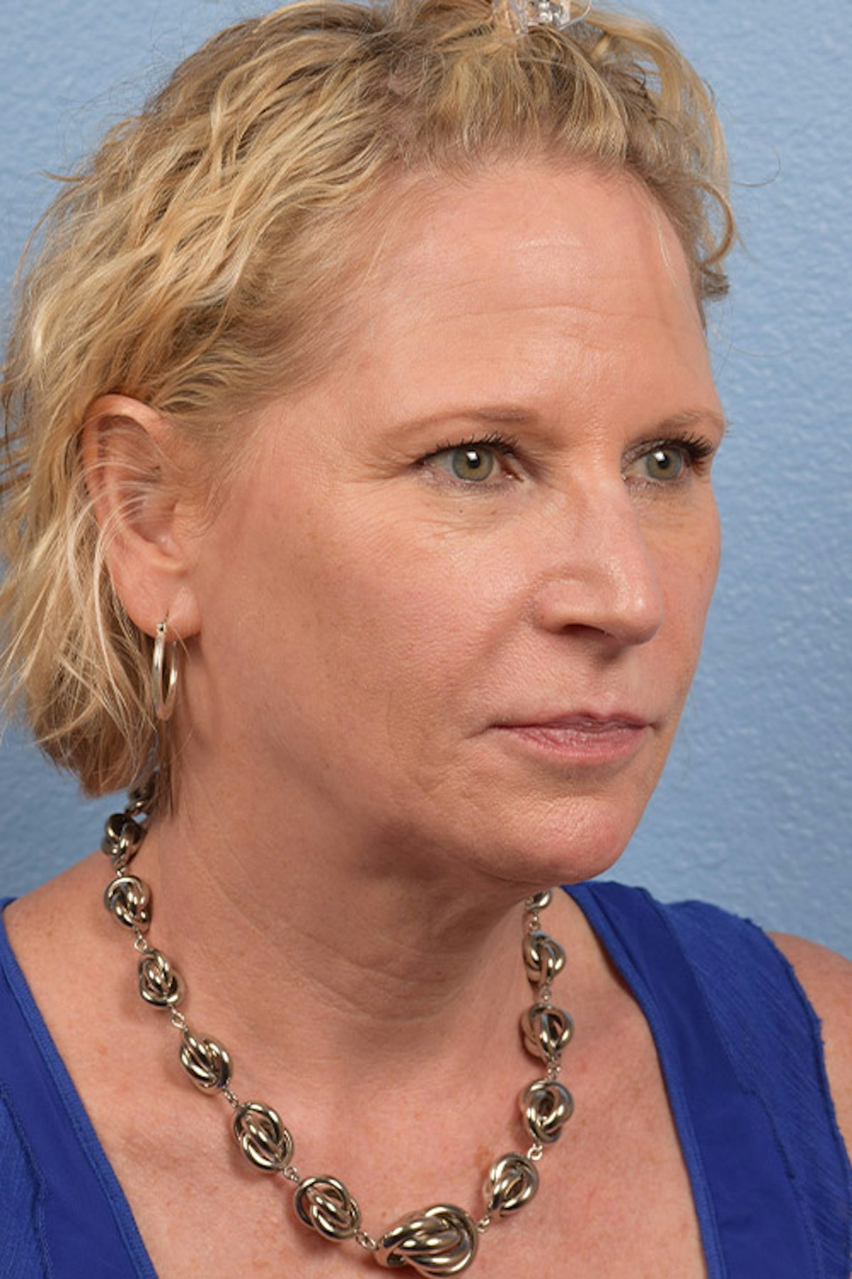 Blepharoplasty Before & After Gallery - Patient 216006 - Image 7