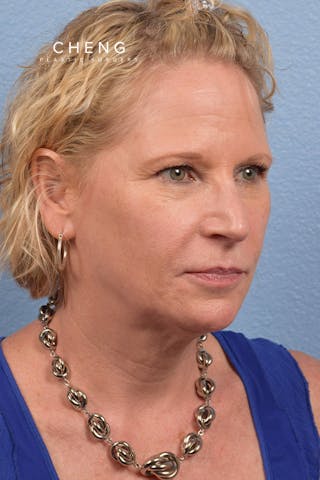 Hidden Patients Before & After Gallery - Patient 530071 - Image 7