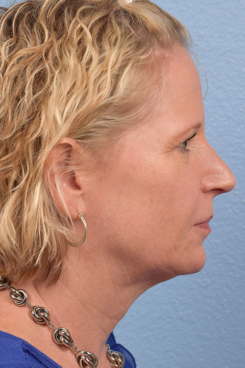 Fat Transfer Before & After Gallery - Patient 313784 - Image 9