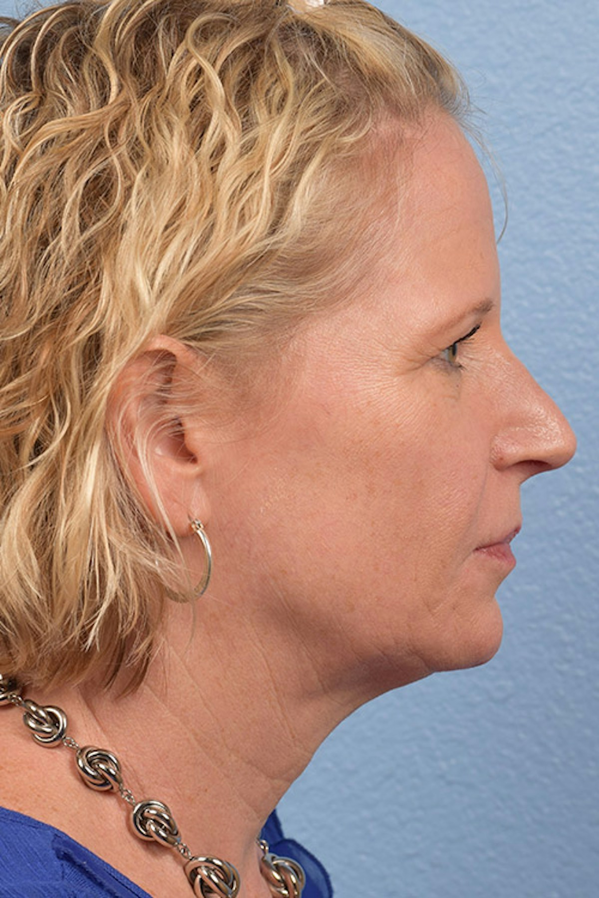 Blepharoplasty Before & After Gallery - Patient 216006 - Image 9