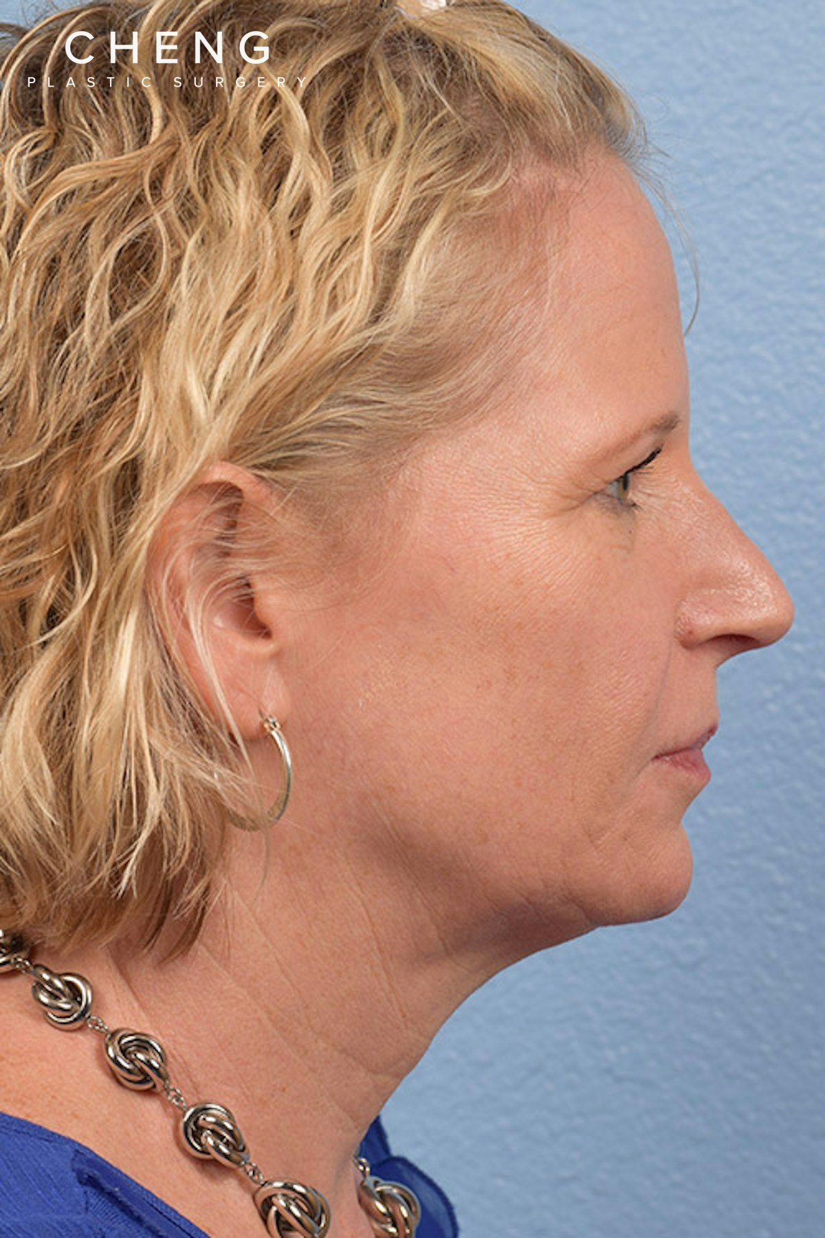 Hidden Patients Before & After Gallery - Patient 530071 - Image 9