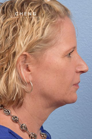 Hidden Patients Before & After Gallery - Patient 530071 - Image 9