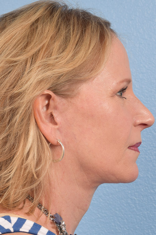 Fat Transfer Before & After Gallery - Patient 313784 - Image 10