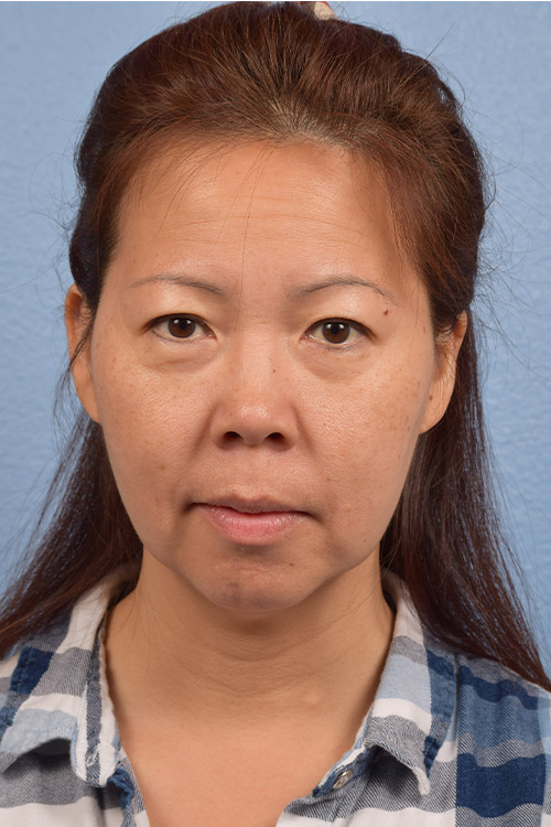 Facelift Before & After Gallery - Patient 384291 - Image 1