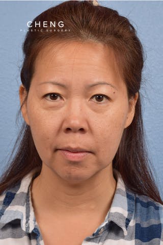 Hidden Patients Before & After Gallery - Patient 272098 - Image 1