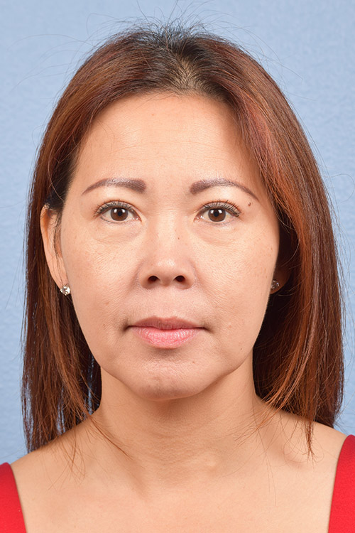 Facelift Before & After Gallery - Patient 384291 - Image 2