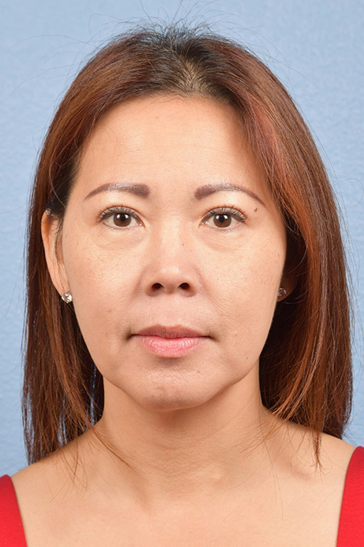 Chin Augmentation Before & After Gallery - Patient 163562 - Image 2