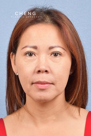 Hidden Patients Before & After Gallery - Patient 272098 - Image 2