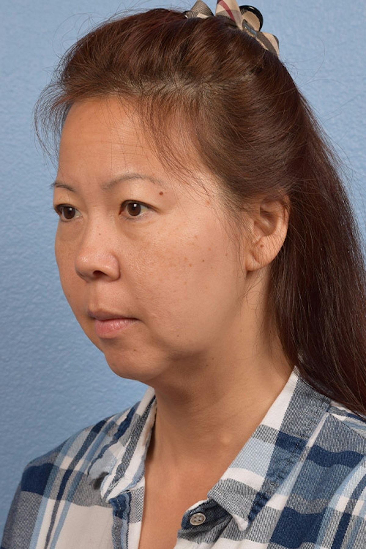 Chin Augmentation Before & After Gallery - Patient 163562 - Image 3