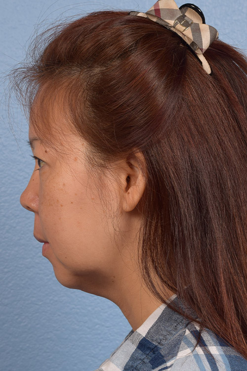 Facelift Before & After Gallery - Patient 384291 - Image 5