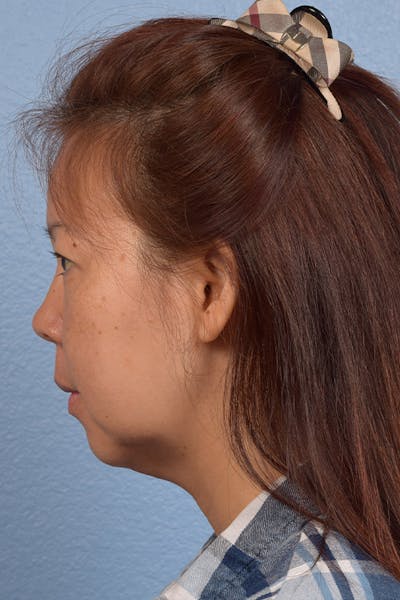 Chin Augmentation Before & After Gallery - Patient 163562 - Image 1