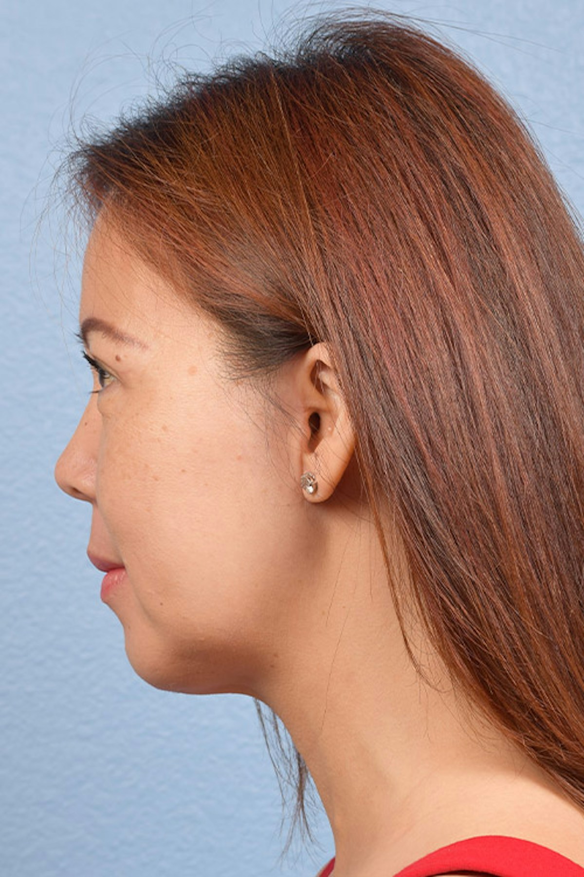 Chin Augmentation Before & After Gallery - Patient 163562 - Image 6