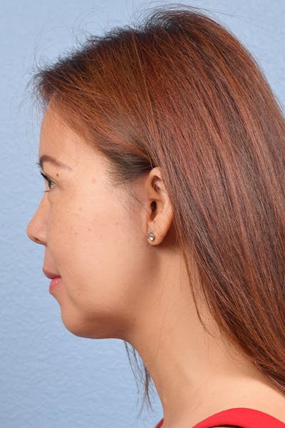 Chin Augmentation Before & After Gallery - Patient 163562 - Image 2