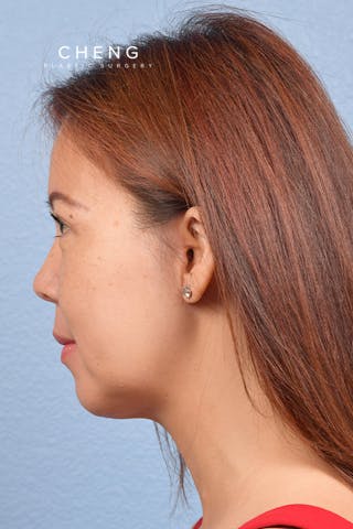 Hidden Patients Before & After Gallery - Patient 272098 - Image 6