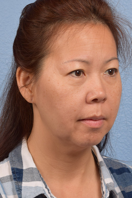 Facelift Before & After Gallery - Patient 384291 - Image 7