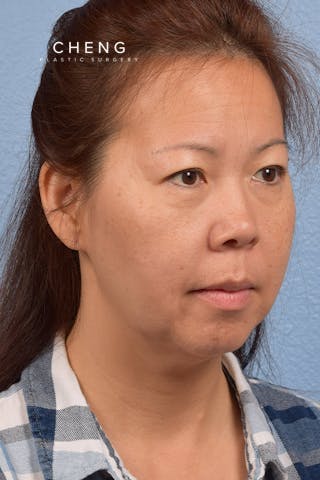 Hidden Patients Before & After Gallery - Patient 272098 - Image 7