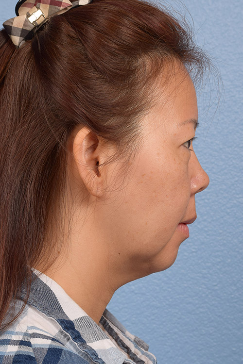 Facelift Before & After Gallery - Patient 384291 - Image 9