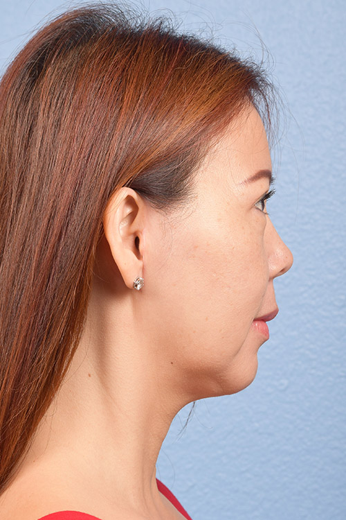 Facelift Before & After Gallery - Patient 384291 - Image 10
