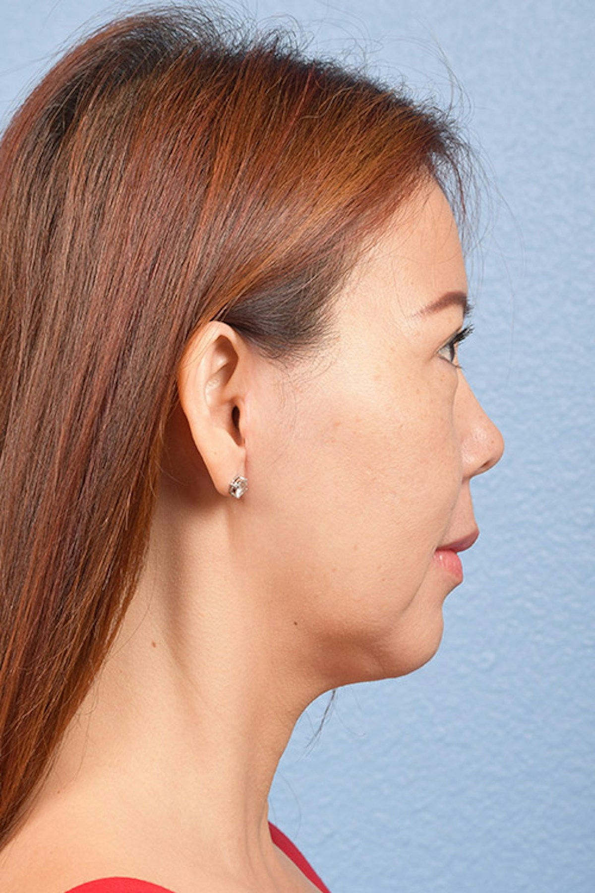 Chin Augmentation Before & After Gallery - Patient 163562 - Image 10