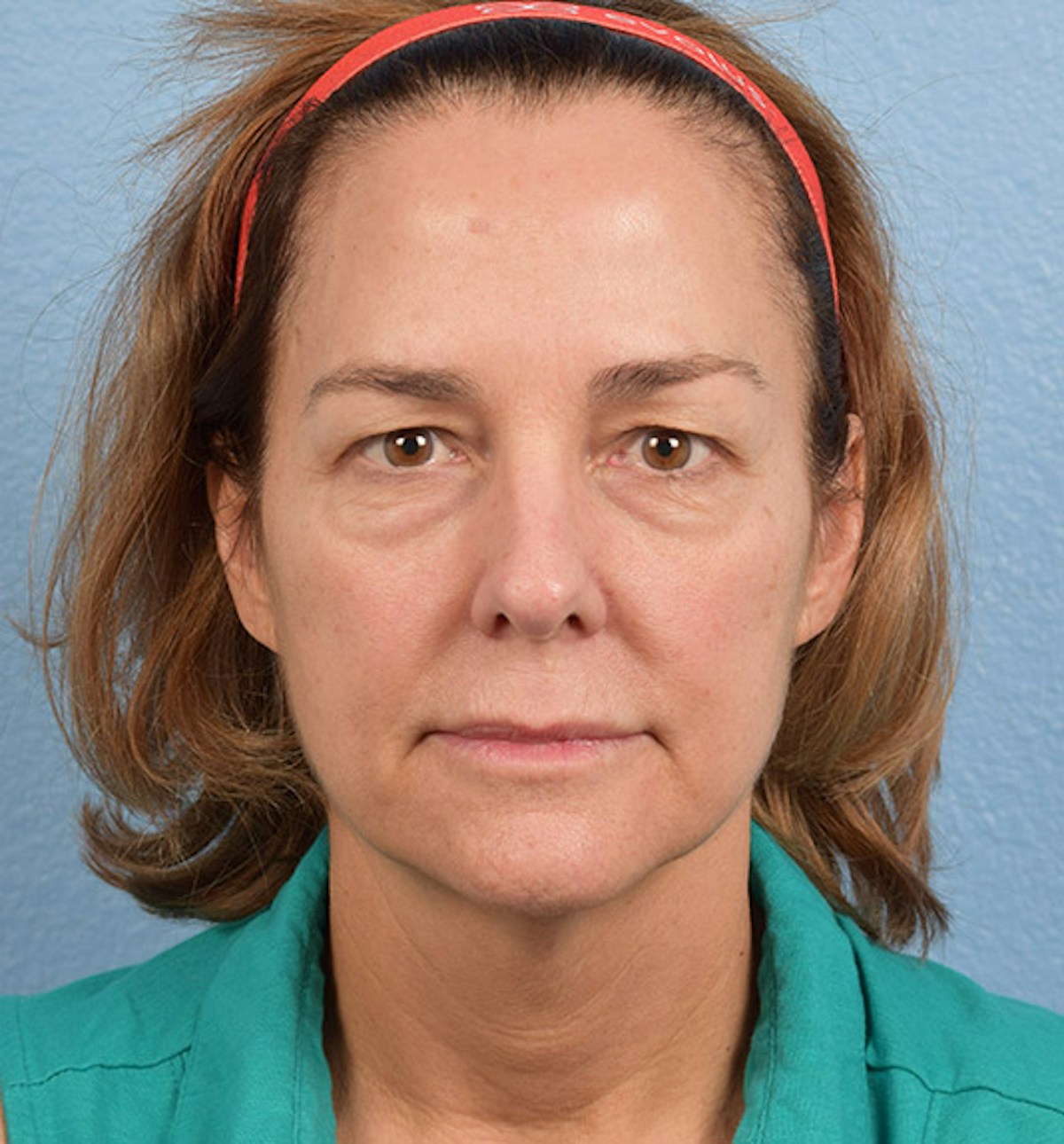 Blepharoplasty Before & After Gallery - Patient 195497 - Image 1
