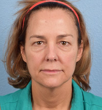 Blepharoplasty Before & After Gallery - Patient 195497 - Image 1