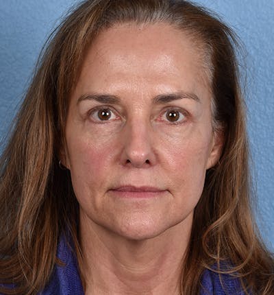 Blepharoplasty Before & After Gallery - Patient 195497 - Image 2