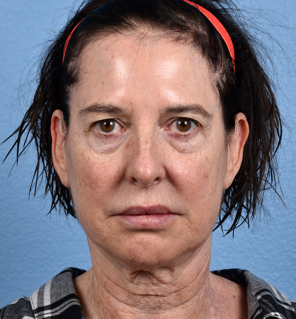 Hidden Patients Before & After Gallery - Patient 345137 - Image 1